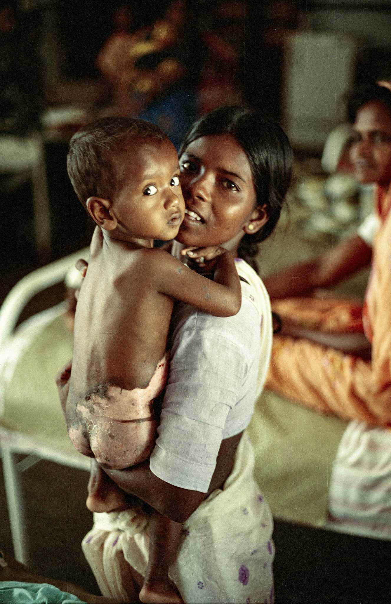Mannar child with Burns