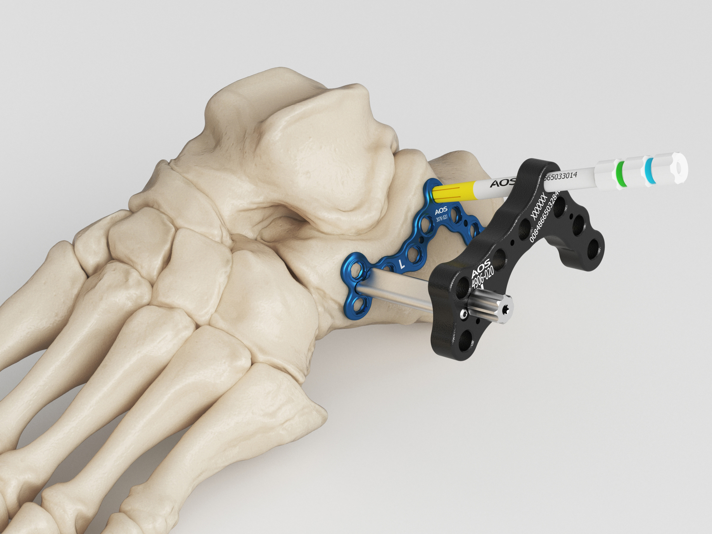 Keith Hyatt - 3d Medical Device Renderings For Aos Ortho