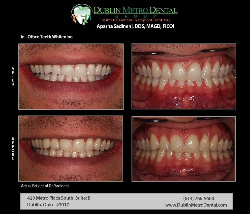 Cosmetic Dentistry, Dental Implants, Teeth Whitening, Before and After