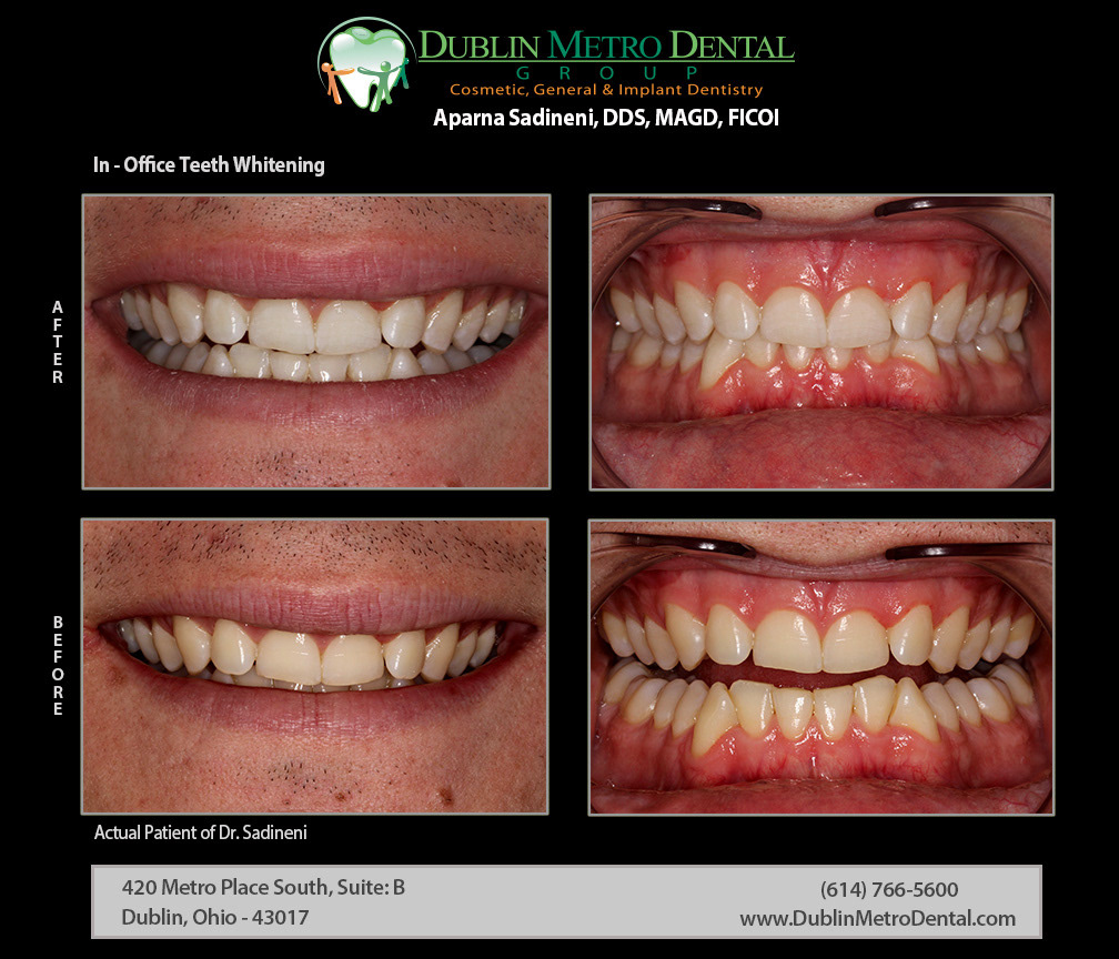 Cosmetic Dentistry Dental Implants Teeth Whitening Before And After Treatment Results 