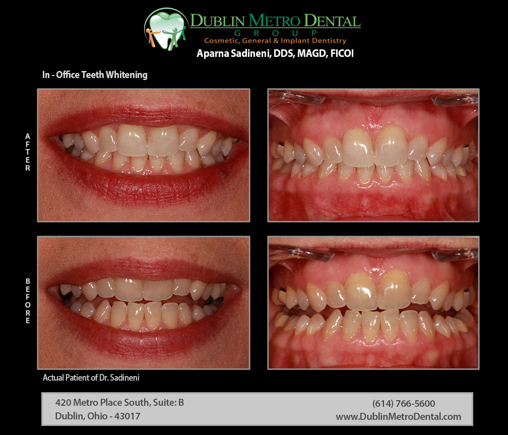 Cosmetic Dentistry Dental Implants Teeth Whitening Before And After Treatment Results 