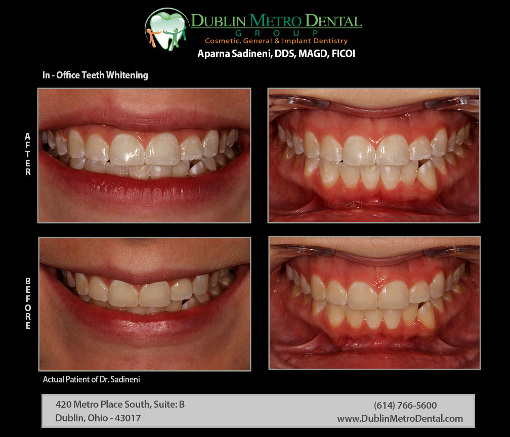 Cosmetic Dentistry, Dental Implants, Teeth Whitening, Before and After