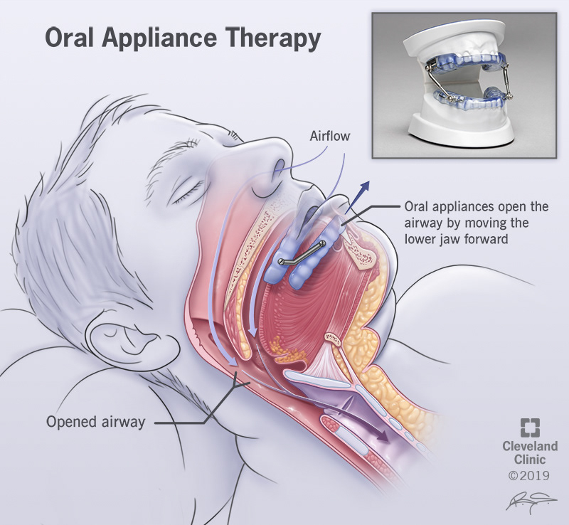 Brandon Stelter Obstructive Sleep Apnea And Oral Appliance Therapy