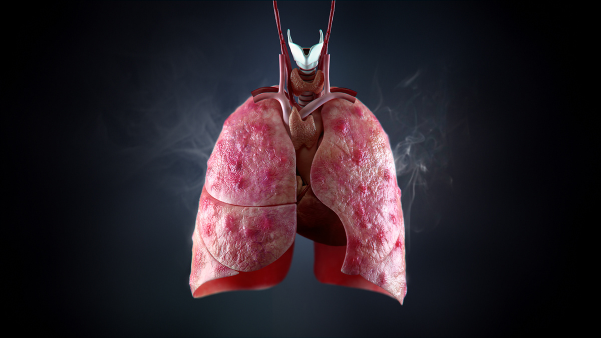 brandon-stelter-vaping-associated-lung-injury