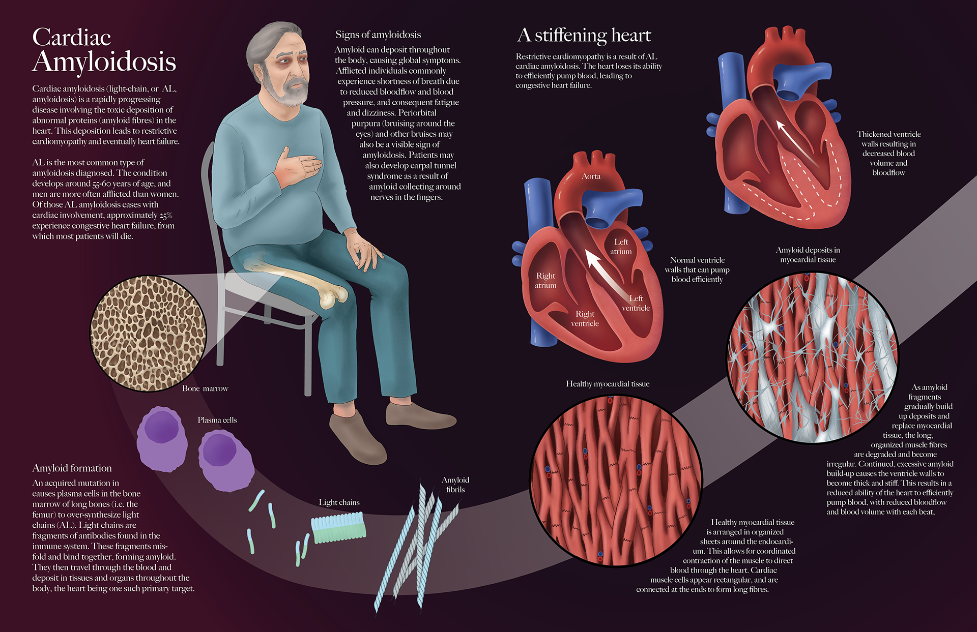 Roxanne Ziman Biomedical Illustrator Cardiac Amyloidosis 1094