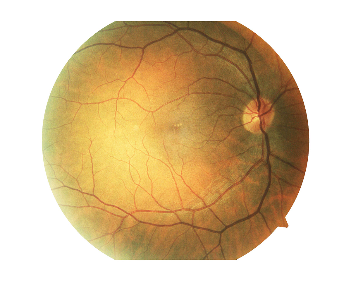 Jose Paulo Andrade MACULA LUTEA