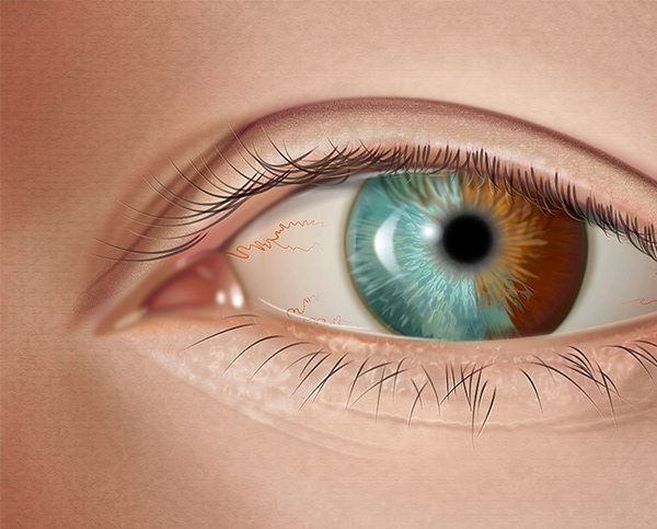 Heterochromia