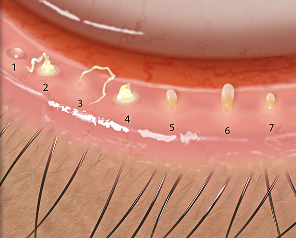 Meibomian Gland Plugging