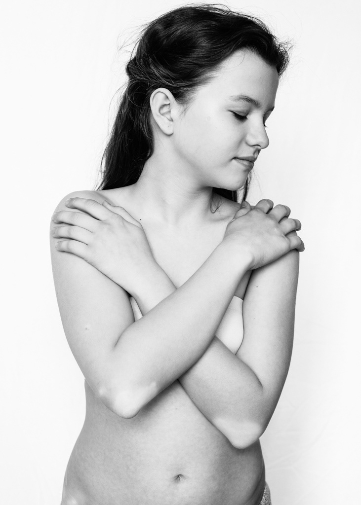 Black and white medium shot, standing. A teenage girl crosses her arms over her chest and looks off to the side with a peaceful expression, reminiscent of a ballet dancer. She has a light skin tone and cone-like patches of vitiligo on both elbows.