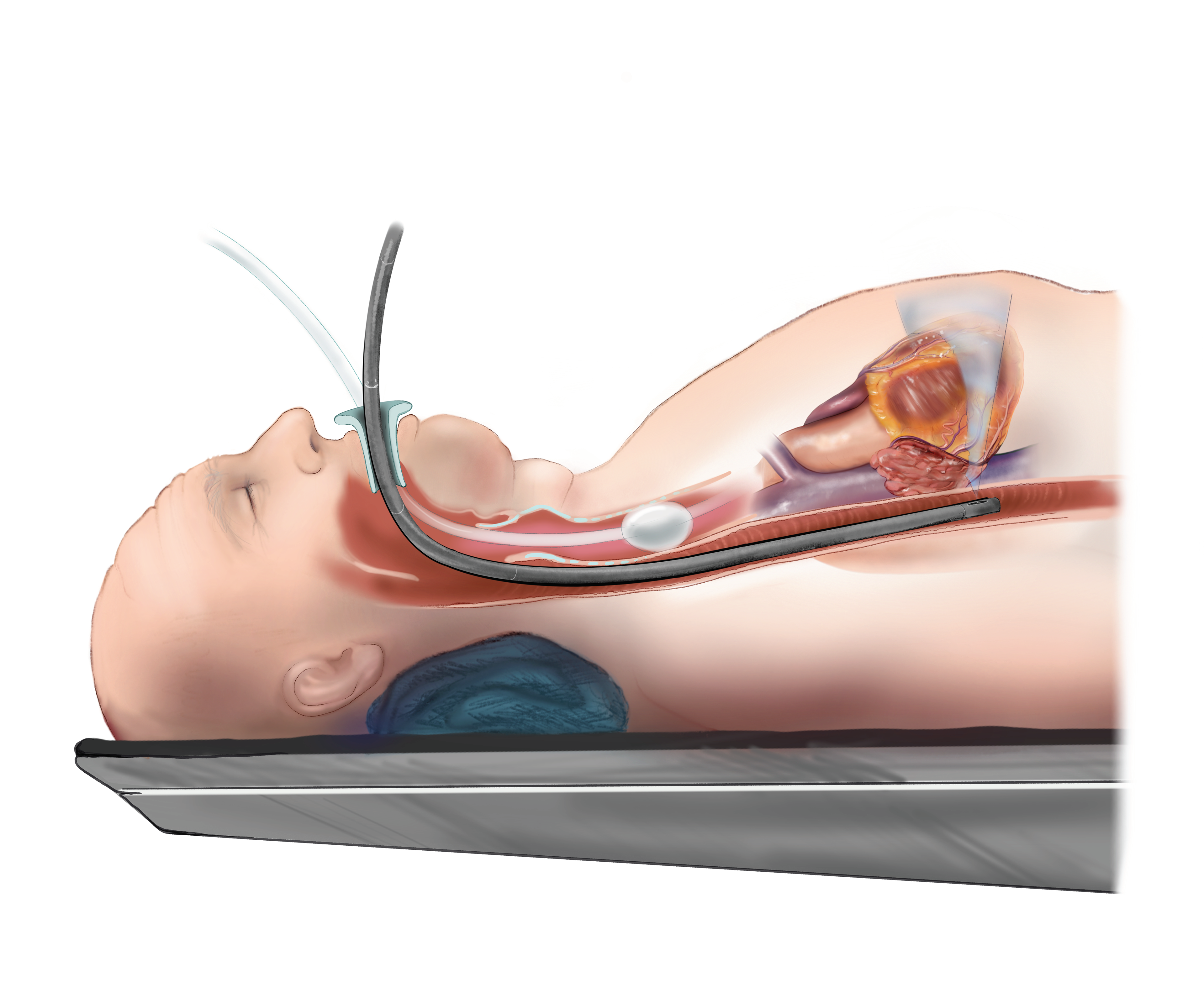 Trans-esophageal echocardiogram (TEE)