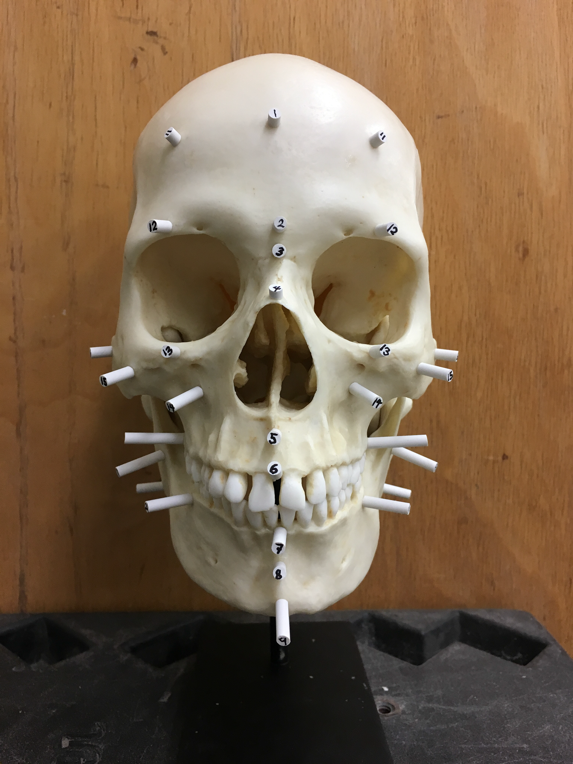 Anterior view of skull with tissue depth markers