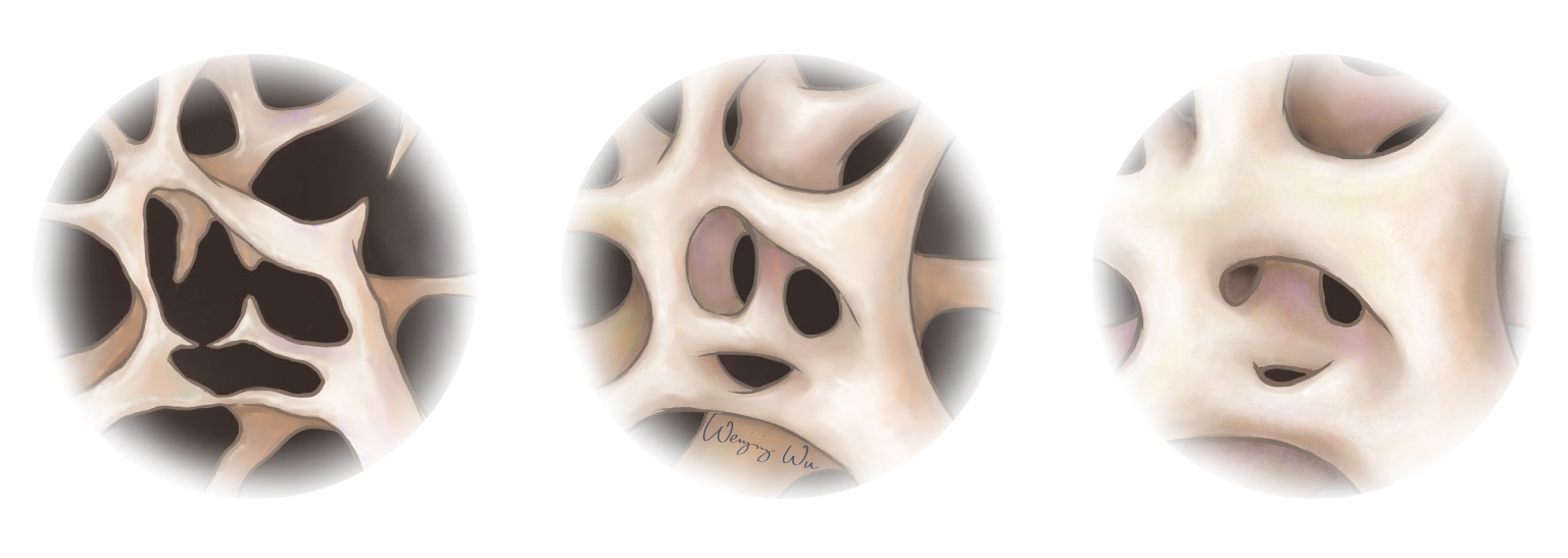 trabeculae: low/normal/high bone mass