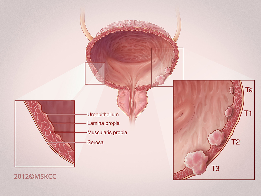 bladder cancer staging